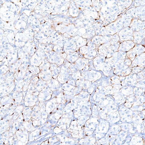File:S100.paraganglioma.sustentacular.4.jpg