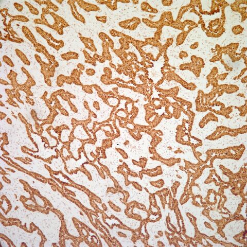 File:Calretinin.mesothelioma.2.jpg