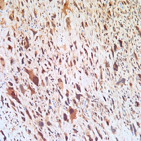 File:CDK4.dedifferentiated liposarcoma.DDL.3.jpg