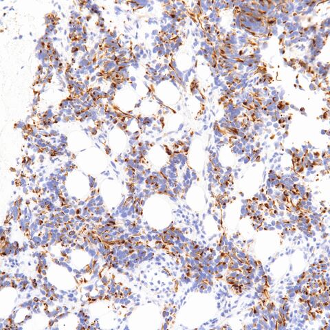 File:Desmin.DSRCT.desmoplastic small round cell tumor.2.jpg