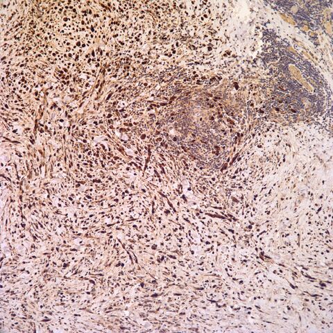 File:S100.desmoplastic neurotropic melanoma.9.jpg
