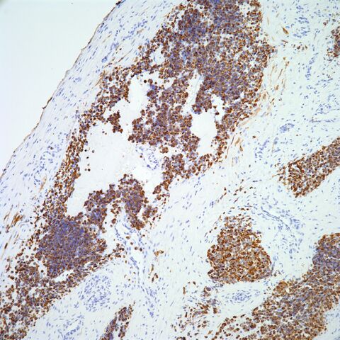 File:Desmin.alveolar rhabdomyosarcoma.4.jpg