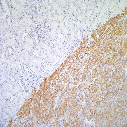 File:Desmin.AML with cyst.5.jpg