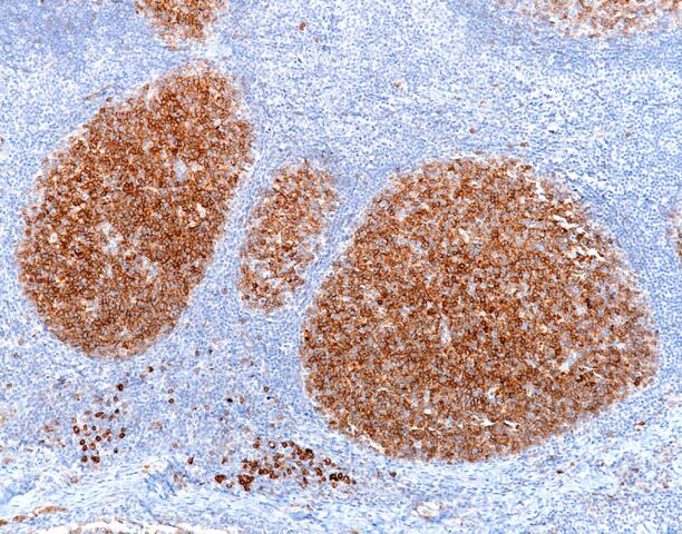 File:CD10.germinal center.100x.jpg