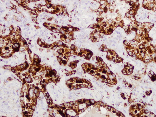File:Low mag primary lung.jpg