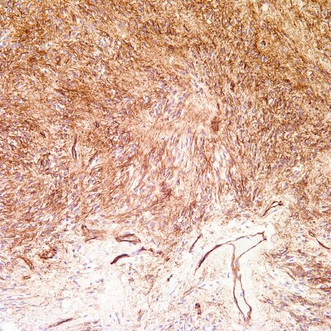 File:Cd34.mammary myofibroblastoma.1.jpg