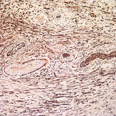 File:S100.desmoplastic neurotropic melanoma.3.jpg