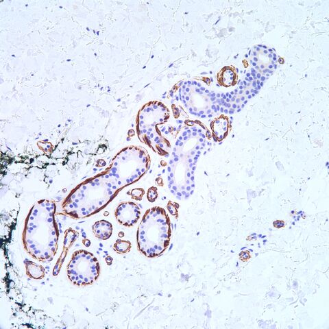 File:MSA.eccrine.jpg
