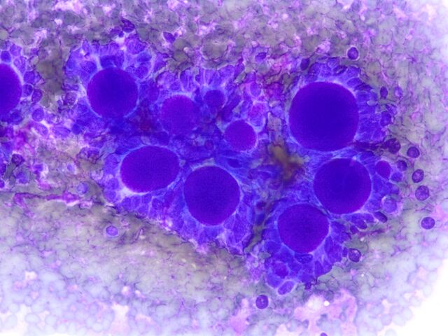 File:Adenoid Cystic Carcinoma5.jpg
