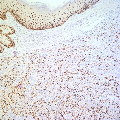 File:P63.sarcomatoid squamous cell carcinoma.3.jpg