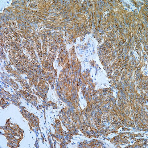 File:CD117.GIST.1.jpg