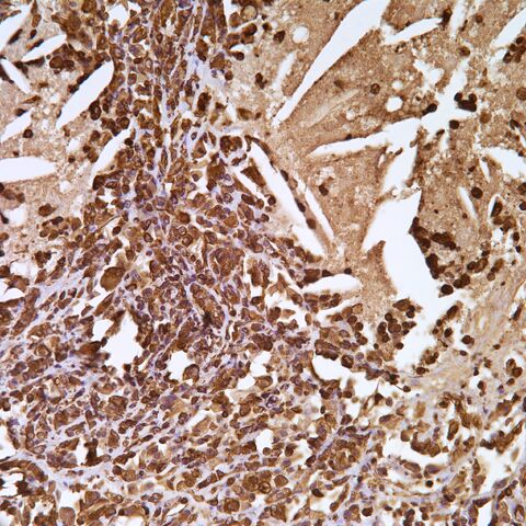 File:Vimentin.xanthogranulomatous.200x.jpg