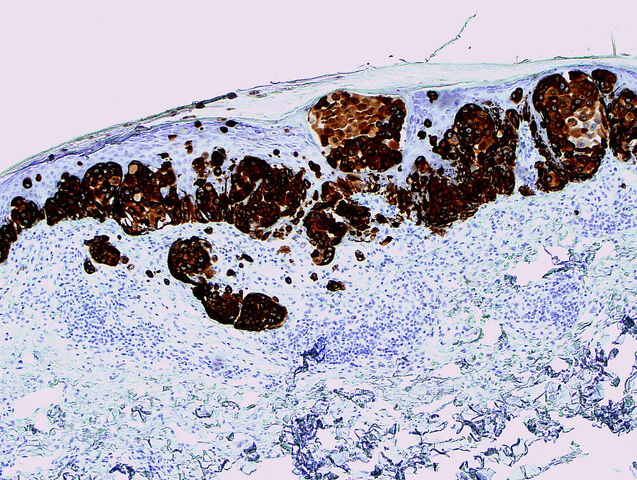 File:A103 invasive melanoma.jpg