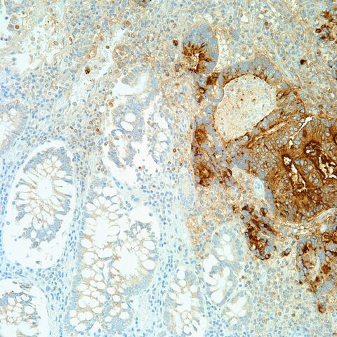 File:B72.3.colonic adenoca.3.jpg
