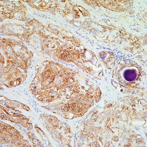 File:EMA.cutaneous meningioma.2.jpg