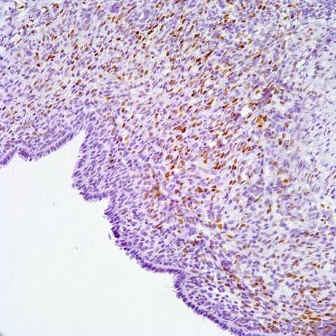 File:PR.AML with cyst.1.jpg