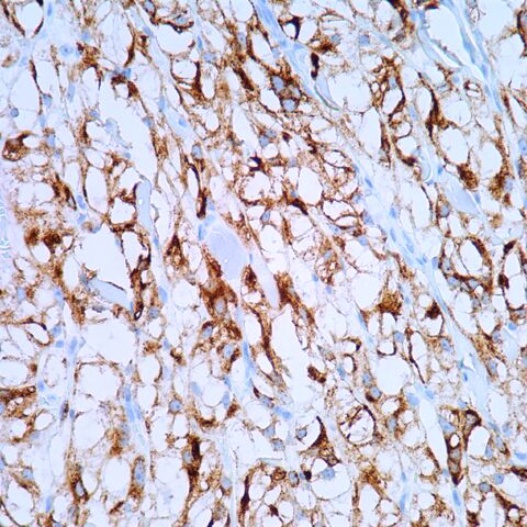File:HMB45.cutaneous pecoma.400x.1.jpg