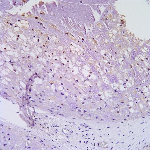File:Brachyury.chordoma.6.jpg