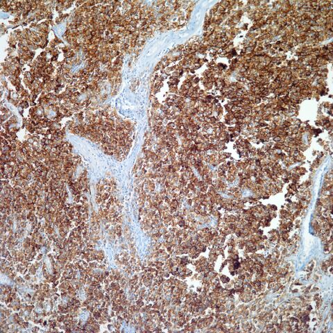 File:PLAP.seminoma.2.jpg