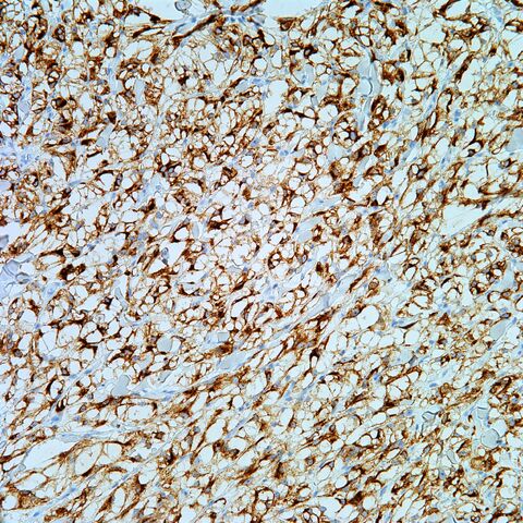 File:HMB45.cutaneous pecoma.100x.jpg