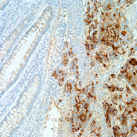 File:B72.3.colonic adenoca.2.jpg