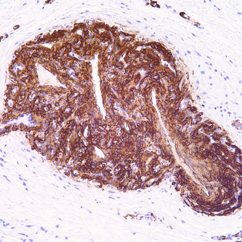 File:SMA.glomangioma.jpg