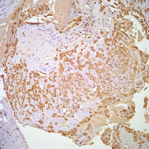 File:S100.myoepithelioma.parachordoma.3.jpg