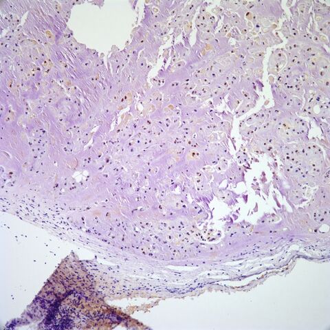 File:Brachyury.chordoma.9.jpg