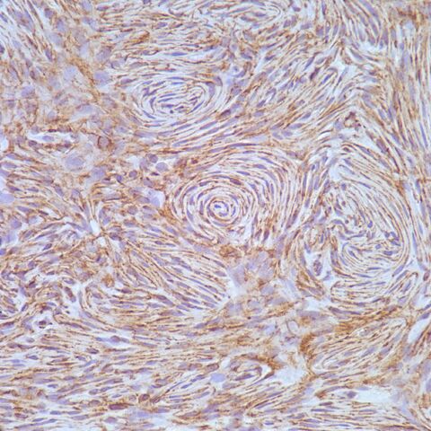 File:Claudin-1.perineurioma.400x.7.jpg