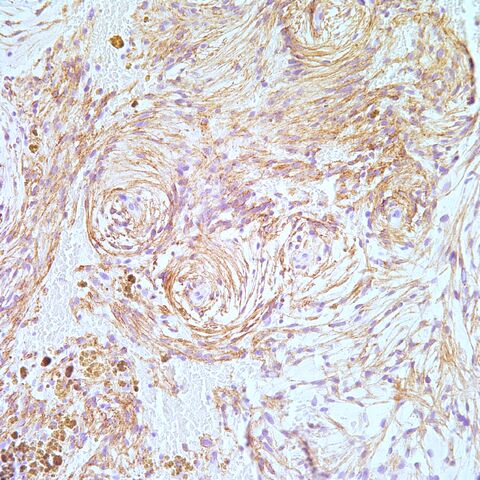 File:EMA.myoepithelioma.jpg