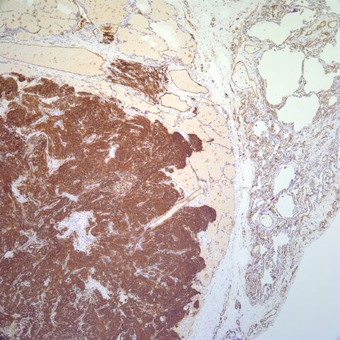 File:CD31.metastatic spindle cell angiosarcoma.4.jpg