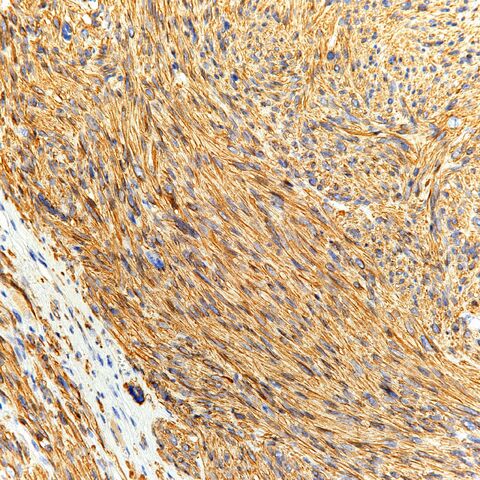 File:MSA.leiomyosarcoma.3.jpg