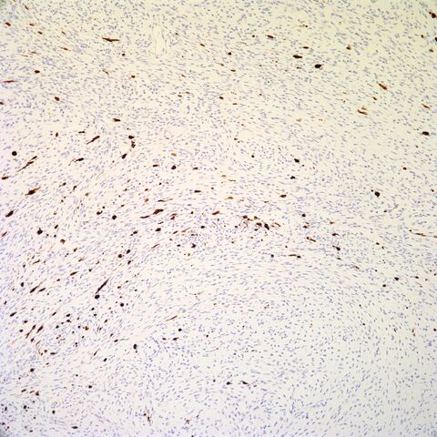 File:Melan-A.pigmented neurofibroma.1.jpg