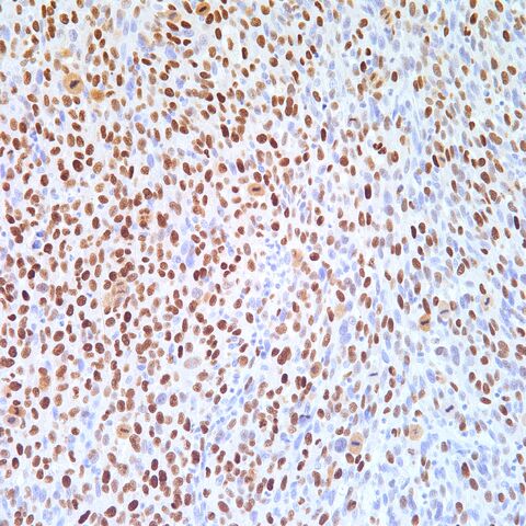 File:P63.sarcomatoid squamous cell carcinoma.2.jpg