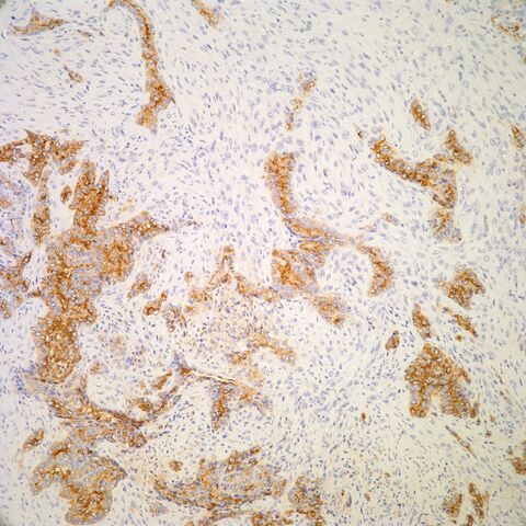 File:HBME-1.mesothelioma.2.jpg