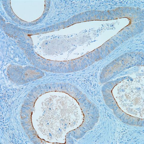 File:Villin.colonic adenoca.3.jpg