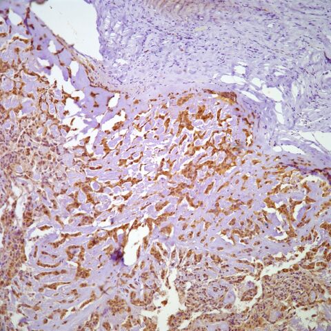 File:S100.myoepithelioma.parachordoma.2.jpg