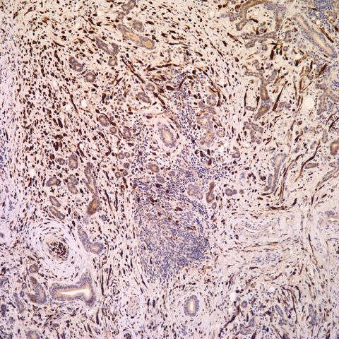 File:S100.desmoplastic neurotropic melanoma.2.jpg