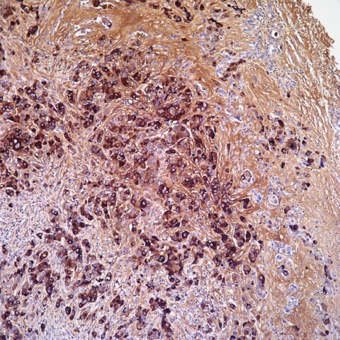 File:BRST2.breast carcinoma.jpg