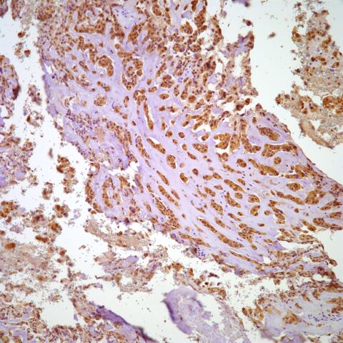 File:S100.myoepithelioma.parachordoma.1.jpg