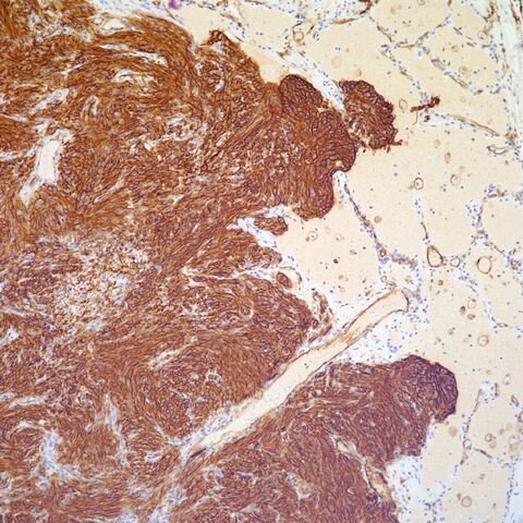 File:CD31.metastatic spindle cell angiosarcoma.3.jpg