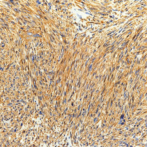 File:MSA.leiomyosarc.HG.2.jpg