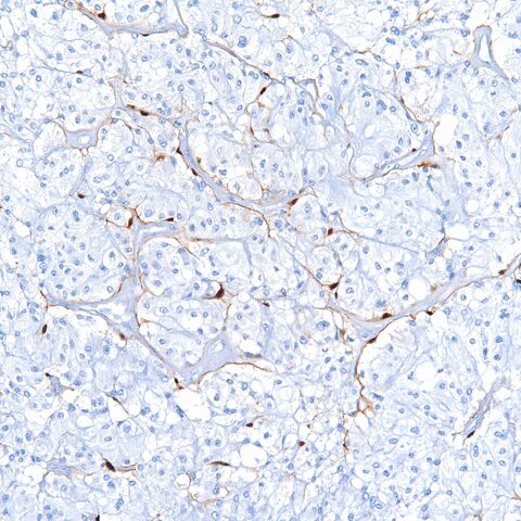 File:S100.paraganglioma.sustentacular.3.jpg