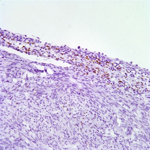 File:PR.AML with cyst.3.jpg