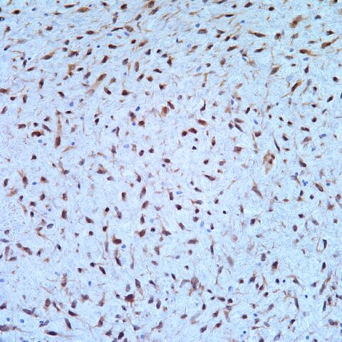 File:CDK4.dedifferentiated liposarcoma.DDL.1.jpg
