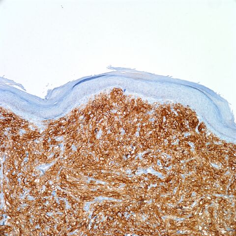File:CD10.cutaneous pecoma.100x.3.jpg