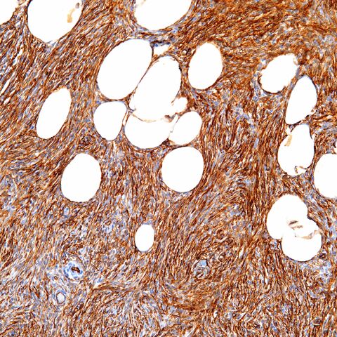 File:CD34.DFSP.200x.jpg
