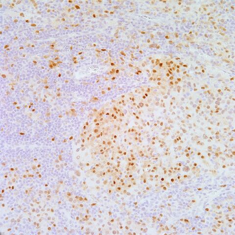 File:MiTF.met melanoma.2.jpg