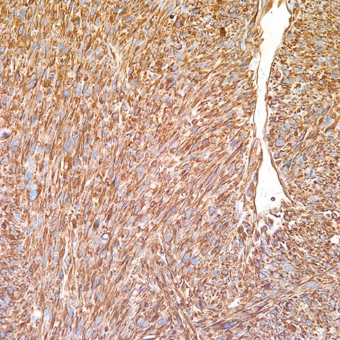 File:Vimentin.cardiac myosarcoma.2.jpg