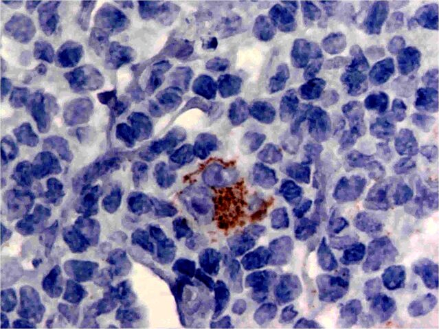 File:CHL-CD15.jpg